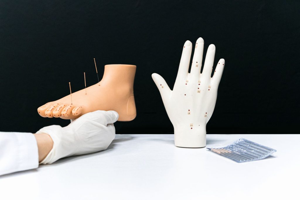 acupuncture points – glowing points on a hand with inserted needles