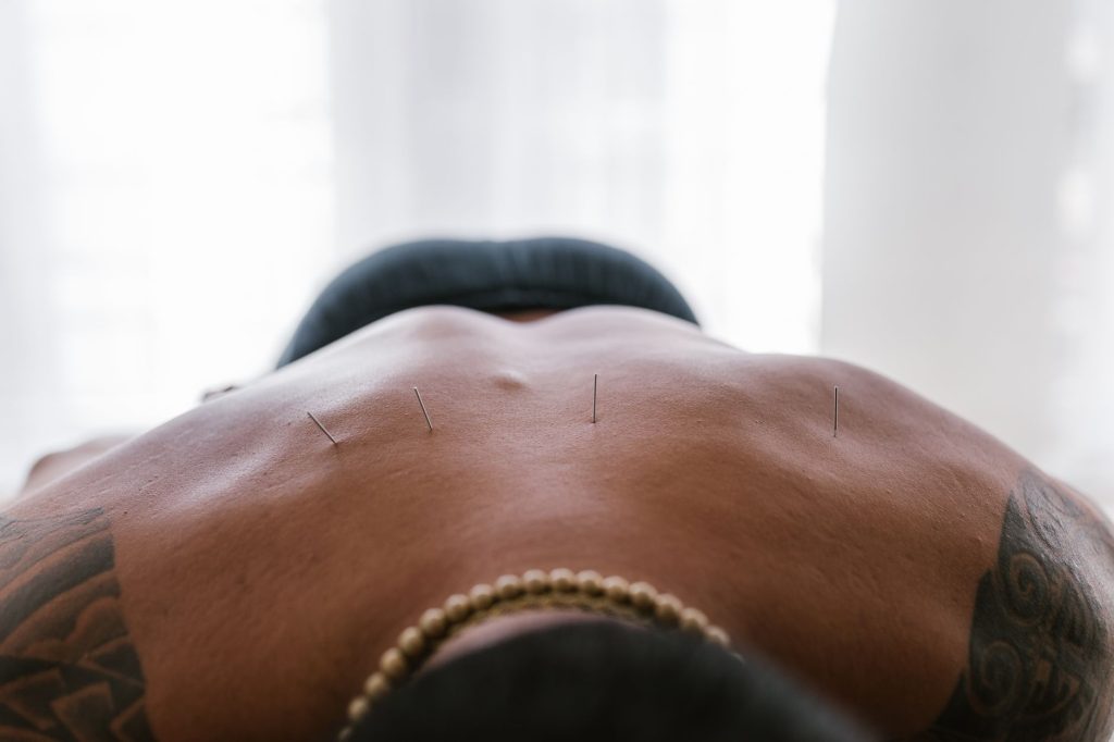 TCM practices – acupuncture needles placed on a patient’s back