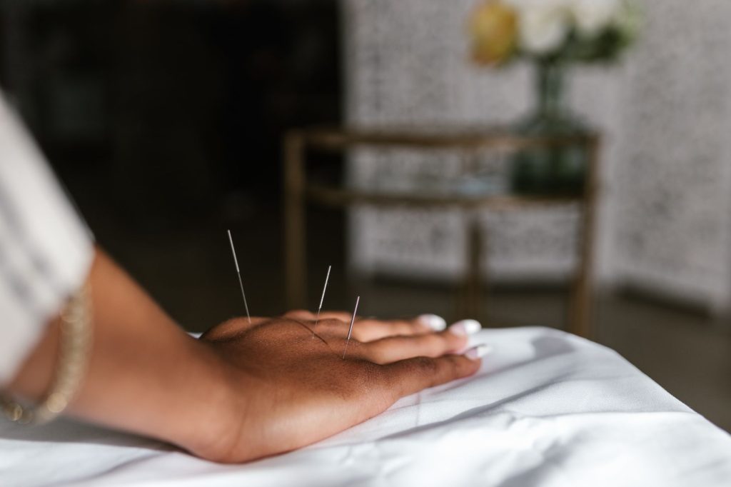 acupuncture benefits – patient receiving treatment with thin needles on back